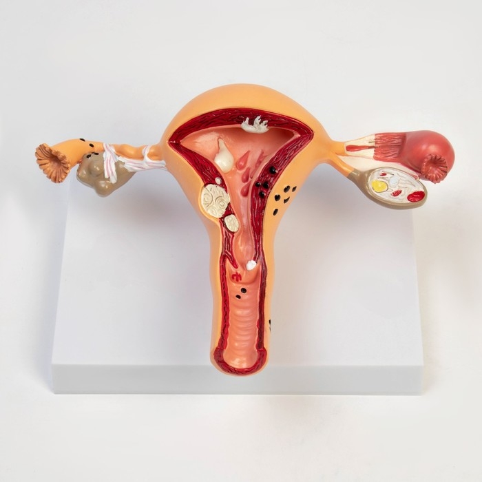 Макет Макет "Органы матки, патологии" 24*12*20см