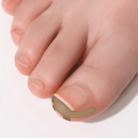 Наклейки против вросших ногтей, 16 шт, цвет бежевый Наклейки против вросших ногтей, 16 шт, цвет бежевый